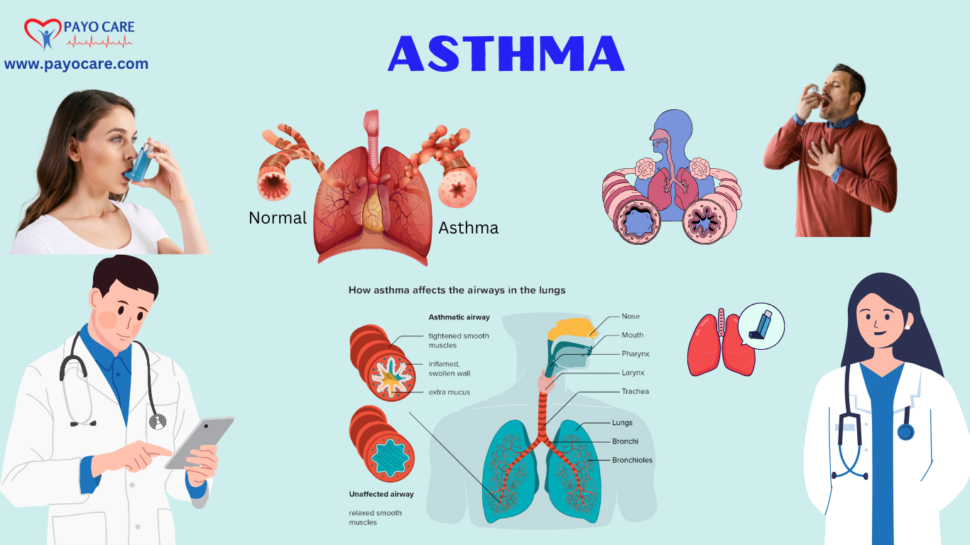 Asthma: Types, Causes, Symptoms, Diagnosis & Treatment