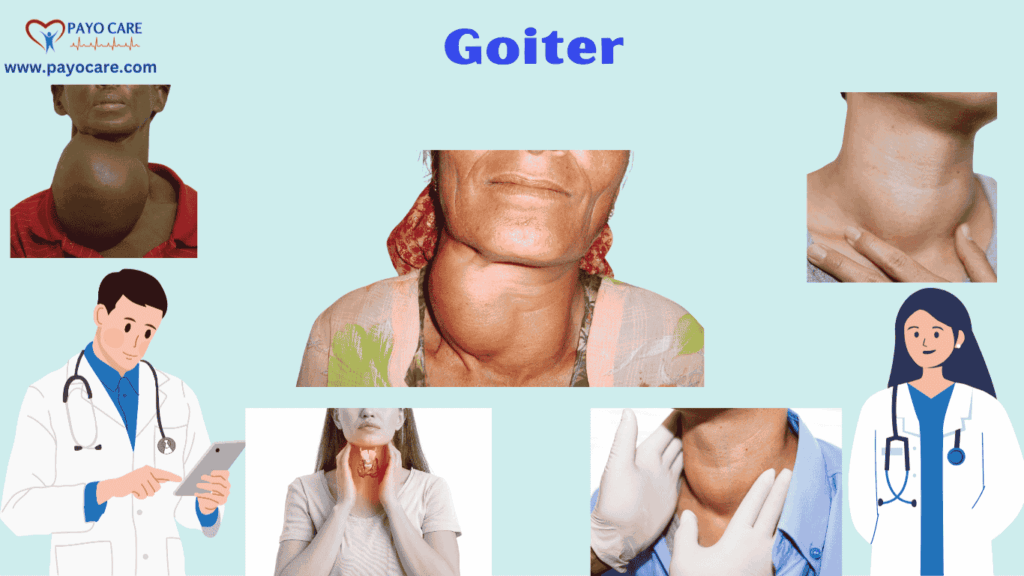 Goiter: Types, Causes, Symptoms, Prevention, 