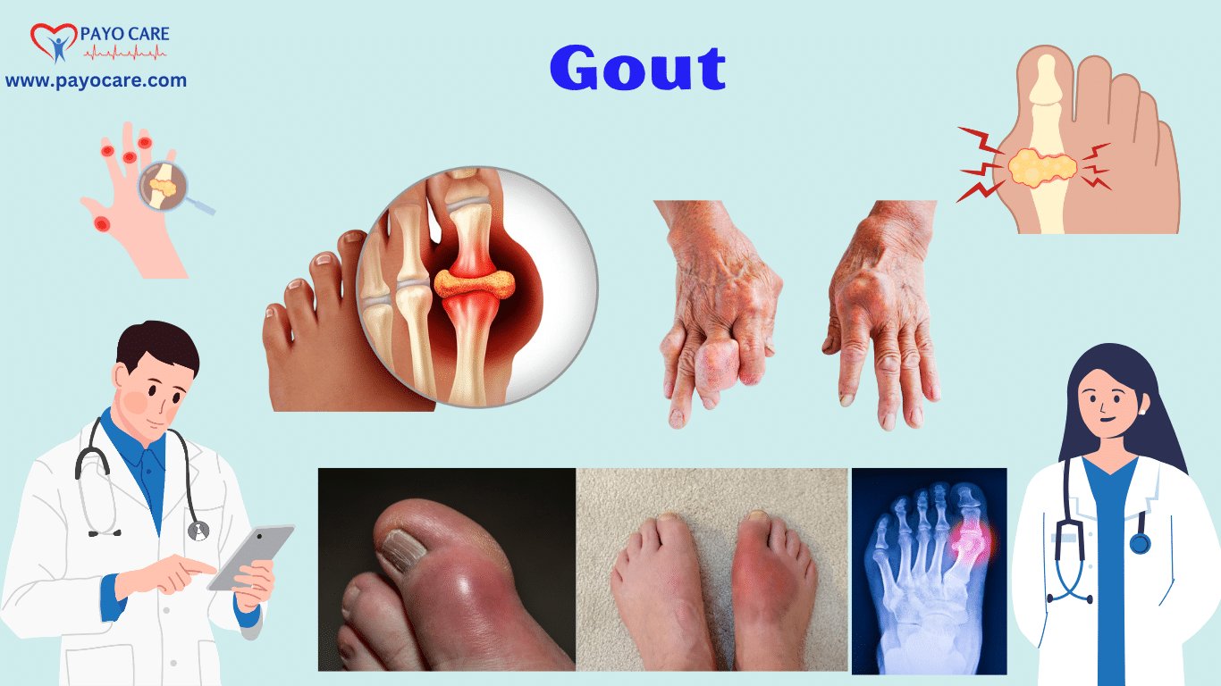 Gout: Types, Causes, Symptoms, Prevention, Diagnosis & Treatment