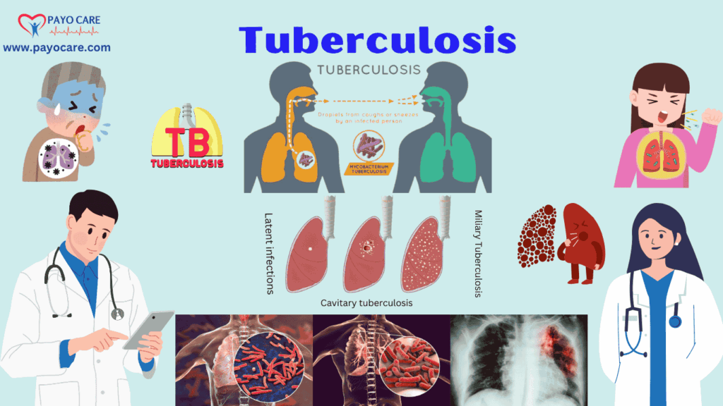 Tuberculosis: Types, Causes, Symptoms, Prevention, Diagnosis & Treatment Tuberculosis: Types, Causes, Symptoms, Prevention, Diagnosis & Treatment