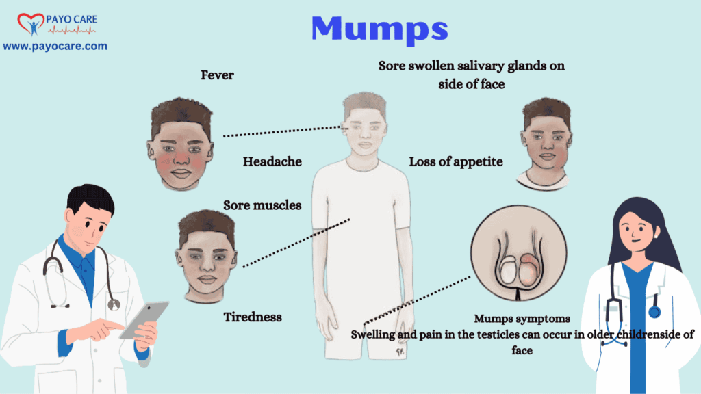 Mumps: Causes, Symptoms, prevention and Treatment Mumps: Causes, Symptoms, prevention and Treatment